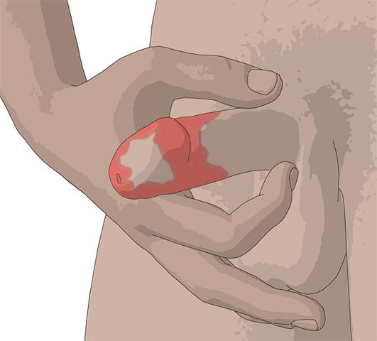 Eigenständige Therapie von Balanitis: Möglichkeiten zur Selbsthilfe