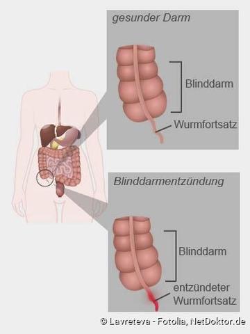 Antibiotika oder Operation? Behandlungsoptionen für eine unkomplizierte Blinddarmentzündung Antibiotika oder Operation? Behandlungsoptionen für eine unkomplizierte Blinddarmentzündung
