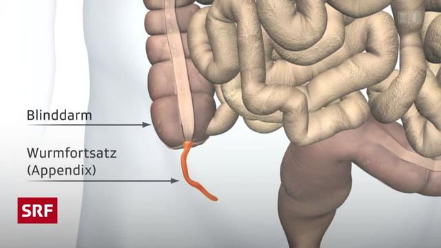 Behandlung der Blinddarmentzündung: Antibiotika als Alternative zur Operation? Behandlung der Blinddarmentzündung: Antibiotika als Alternative zur Operation?