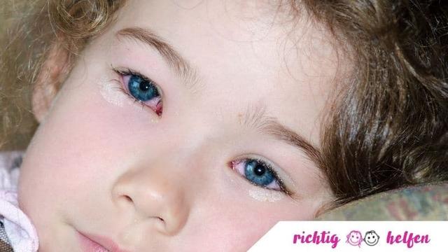 Ursachen und Behandlung von infektiöser Bindehautentzündung bei Kindern Ursachen und Behandlung von infektiöser Bindehautentzündung bei Kindern
