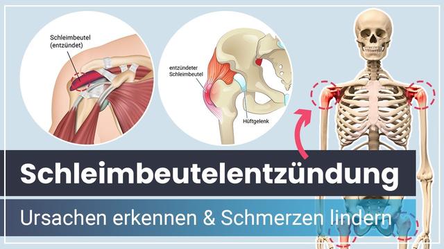 Linderung bei Schleimbeutelentzündung: Hilfreiche Tipps und Tricks Linderung bei Schleimbeutelentzündung: Hilfreiche Tipps und Tricks
