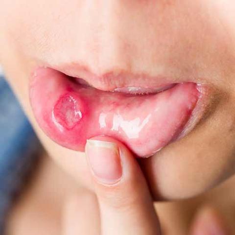 Ernährung und Mundpflege bei Aphthen: Was beachten?