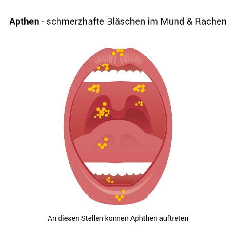 Selbsthilfe bei Aphthen: Tipps zur Behandlung und Vorbeugung
