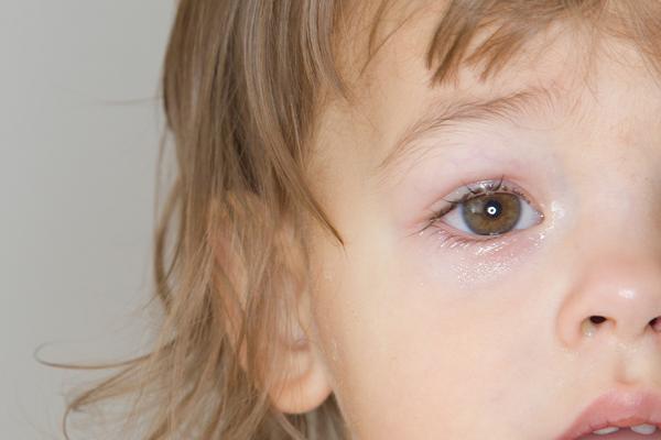 Tipps zur Behandlung von Bindehautentzündung bei Kindern Tipps zur Behandlung von Bindehautentzündung bei Kindern