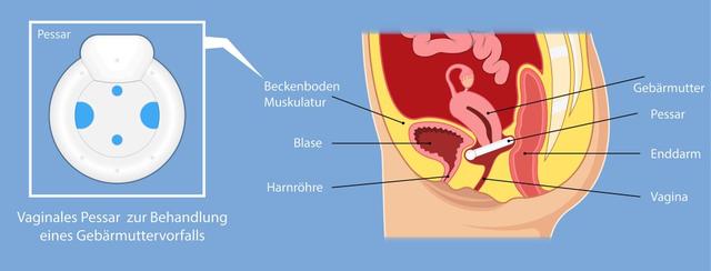Zeitpunkt für den Arztbesuch bei einer Gebärmuttersenkung