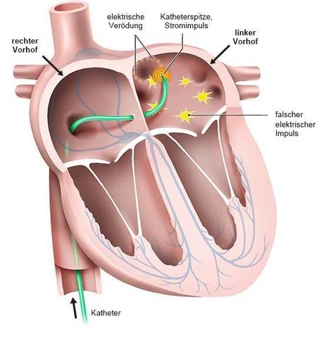 Katheterablation bei Herzrhythmusstörungen: Erfolgsaussichten und Risiken Katheterablation bei Herzrhythmusstörungen: Erfolgsaussichten und Risiken
