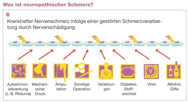Alles über neuropathische Schmerzen: Ursachen und Behandlungsmöglichkeiten