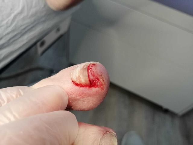 Eingewachsener Zehennagel: Selbsthilfe und Behandlungsmethoden