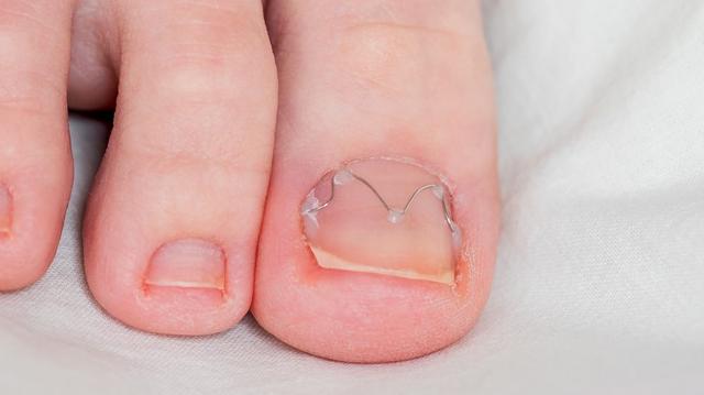 Effektive Maßnahmen gegen einen eingewachsenen Zehennagel