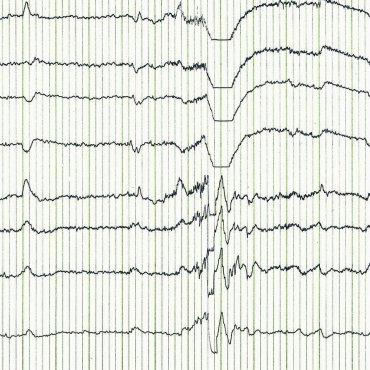 EEG-Anwendungsbereiche: Welche Informationen liefert ein EEG?