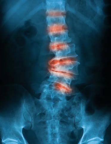 Vorbeugung und Prävention von Spondylose: Tipps für eine gesunde Wirbelsäule Vorbeugung und Prävention von Spondylose: Tipps für eine gesunde Wirbelsäule