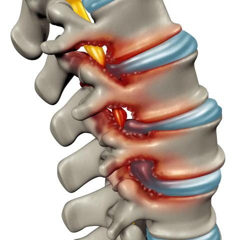 Spondylose: Eine degenerative Erkrankung der Wirbelsäule im Überblick Spondylose: Eine degenerative Erkrankung der Wirbelsäule im Überblick