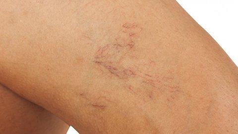 Behandlung von Besenreisern: Welche Geräte eignen sich zur Selbstentfernung? Behandlung von Besenreisern: Welche Geräte eignen sich zur Selbstentfernung?