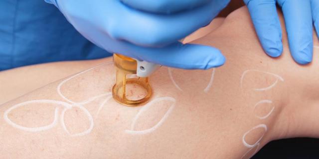 Hausgeräte zur Entfernung von Besenreisern: Was funktioniert am besten? Hausgeräte zur Entfernung von Besenreisern: Was funktioniert am besten?