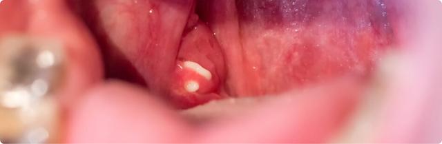 Mundgeruch durch Mandelsteine: Was tun dagegen? Mundgeruch durch Mandelsteine: Was tun dagegen?