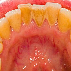 Ausgerenkter Kiefer: Was Sie tun sollten und wie Sie Hilfe bekommen können