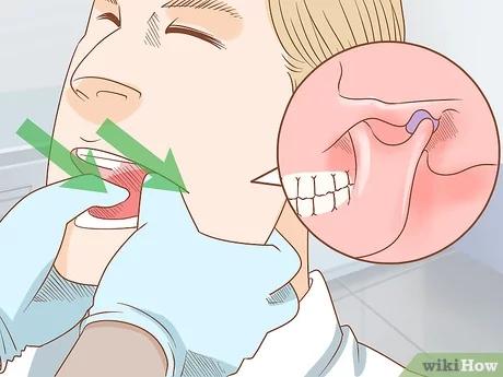 Wie kann ein ausgerenkter Kiefer wieder eingerenkt werden? Behandlungsoptionen