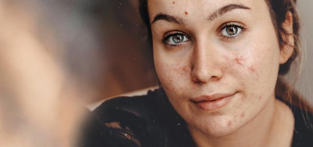 Effektive Maßnahmen gegen hormonelle Akne Effektive Maßnahmen gegen hormonelle Akne