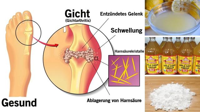 Rasche Senkung des Harnsäurespiegels: Was wirklich funktioniert