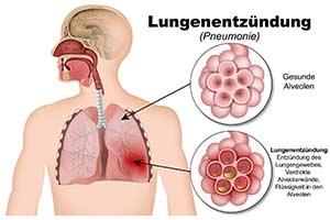Rippenprellung: Wann zum Arzt gehen und wie man die Heilung unterstützen kann Rippenprellung: Wann zum Arzt gehen und wie man die Heilung unterstützen kann