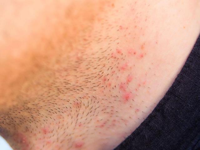 Was tun gegen Rasierpickel? Die besten Hausmittel im Überblick Was tun gegen Rasierpickel? Die besten Hausmittel im Überblick