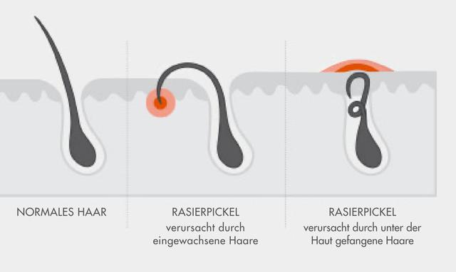 Expertentipps gegen Rasierpickel: So pflegst Du Deine Haut richtig Expertentipps gegen Rasierpickel: So pflegst Du Deine Haut richtig