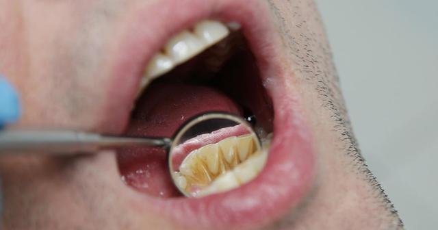 Hausmittel gegen schwarze Stellen am Zahn: Methoden zur Entfernung von Verfärbungen zu Hause Hausmittel gegen schwarze Stellen am Zahn: Methoden zur Entfernung von Verfärbungen zu Hause