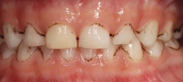 Natürliche Wege, um schwarze Flecken auf den Zähnen loszuwerden: Hausmittel zur sicheren Entfernung von Verfärbungen Natürliche Wege, um schwarze Flecken auf den Zähnen loszuwerden: Hausmittel zur sicheren Entfernung von Verfärbungen