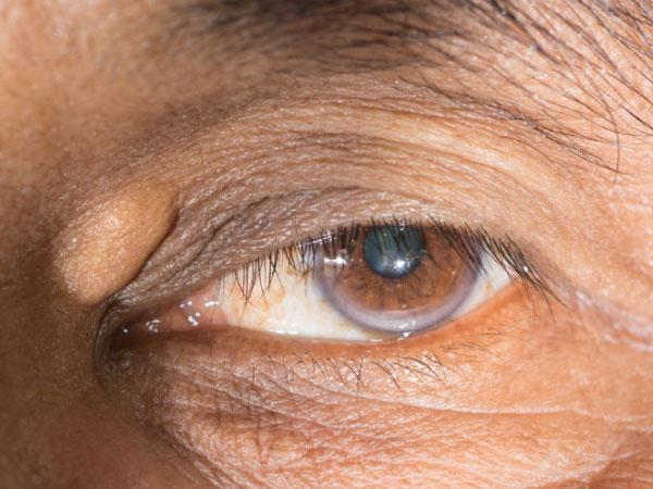 Xanthelasmen am Auge: Behandlungsmöglichkeiten und Ursachen Xanthelasmen am Auge: Behandlungsmöglichkeiten und Ursachen