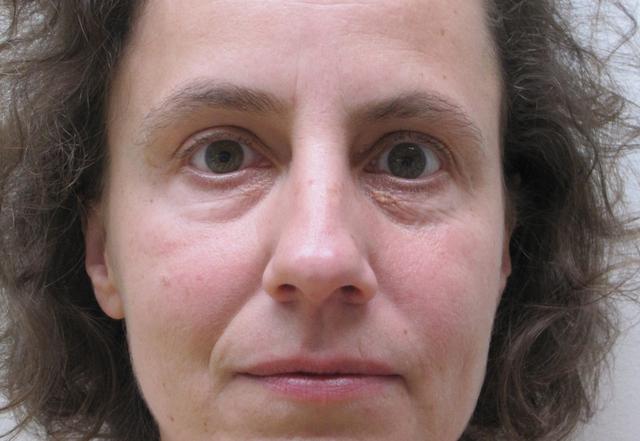 Ästhetische Lösung für Fettablagerungen am Auge gesucht? Ästhetische Lösung für Fettablagerungen am Auge gesucht?