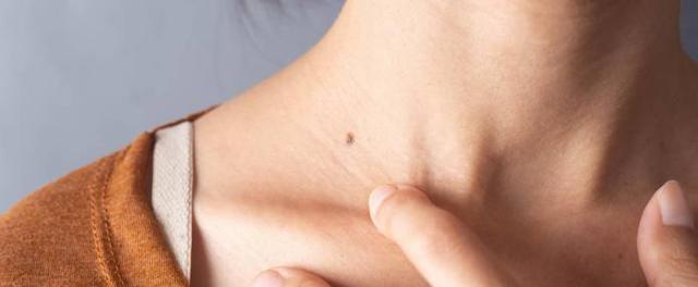 Fibrome im Gesicht und am Hals: Ästhetisch störend, aber ungefährlich Fibrome im Gesicht und am Hals: Ästhetisch störend, aber ungefährlich