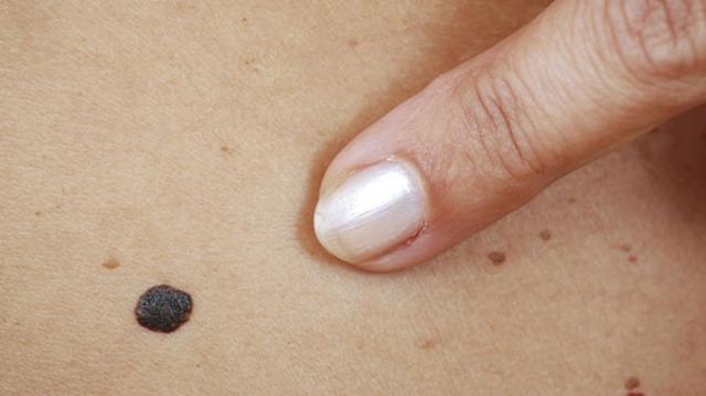 Fibrome entfernen lassen: Schnelle und sichere Behandlung beim Hautarzt Fibrome entfernen lassen: Schnelle und sichere Behandlung beim Hautarzt