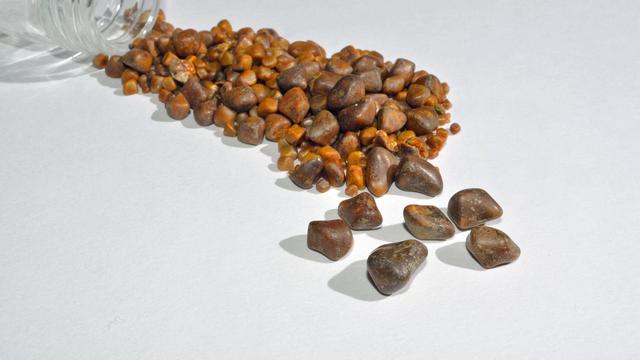 Cholesterin- und Pigmentsteine: Die verschiedenen Arten von Gallensteinen erklärt