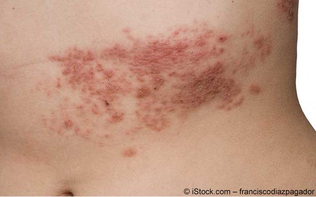 Impfung gegen Gürtelrose: Dauer der möglichen Nebenwirkungen