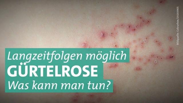 Nebenwirkungen nach Impfung gegen Gürtelrose: Wie lange halten sie an?