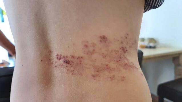 Impfung gegen Gürtelrose: Nebenwirkungen und Dauer