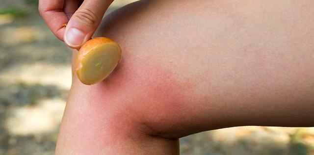 Was tun nach einem Wespenstich? Wirksame Tipps zur Linderung der Beschwerden Was tun nach einem Wespenstich? Wirksame Tipps zur Linderung der Beschwerden