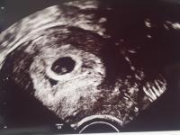 Ab wann ist der Herzschlag im Ultraschall sichtbar? Ab wann ist der Herzschlag im Ultraschall sichtbar?