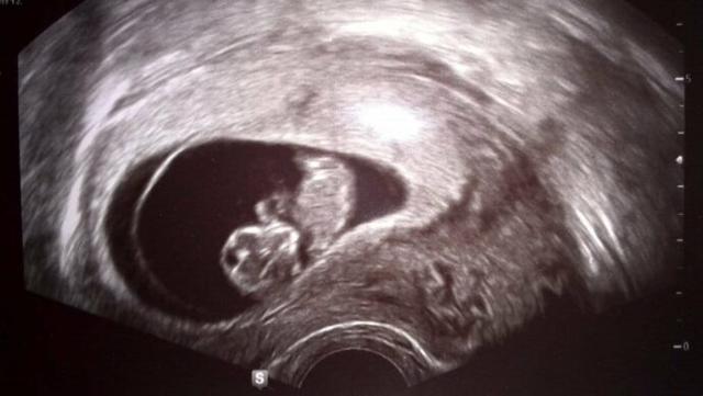 Ab welchem Zeitpunkt kann man den Herzschlag des Fetus im Ultraschall feststellen? Ab welchem Zeitpunkt kann man den Herzschlag des Fetus im Ultraschall feststellen?