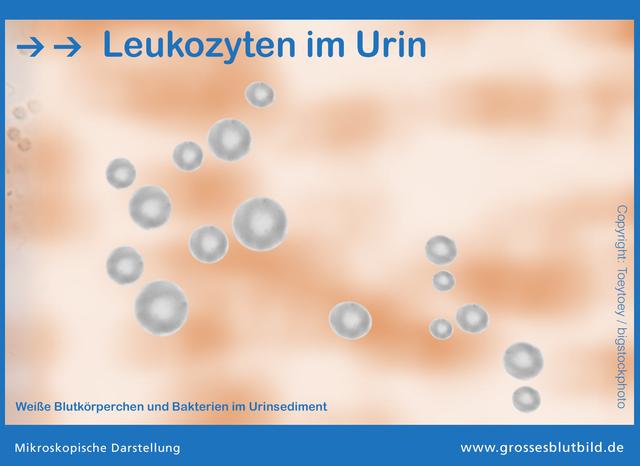 Hausmittel gegen Leukozyten im Urin