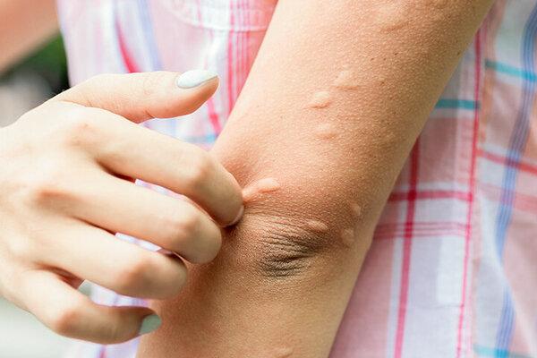 Mückenstiche behandeln: Tipps und Tricks für eine schnelle Heilung Mückenstiche behandeln: Tipps und Tricks für eine schnelle Heilung