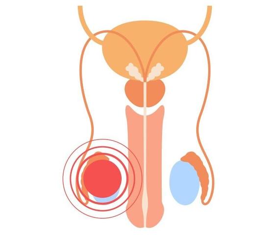 Hodentorsion: Schnelle Behandlung notwendig für Hodenerhalt Hodentorsion: Schnelle Behandlung notwendig für Hodenerhalt