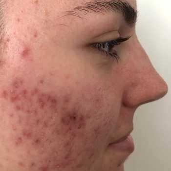 Die Rolle der Ernährung bei der Entstehung von hormoneller Akne Die Rolle der Ernährung bei der Entstehung von hormoneller Akne