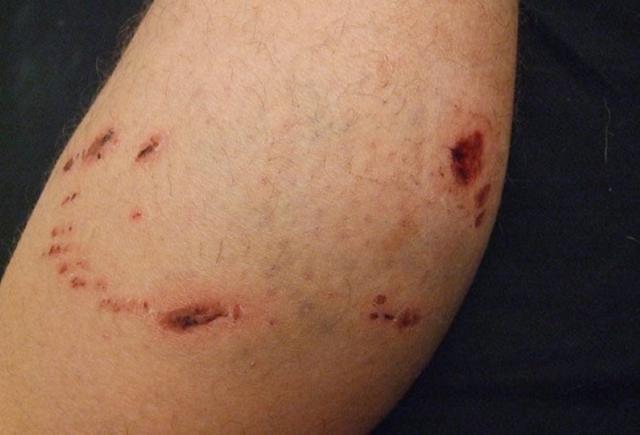 Bei einem Hundebiss zum Arzt: Wann ist es erforderlich?