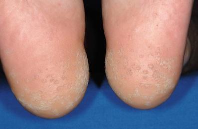 Natürliche Heilmittel gegen Keratoma sulcatum: Wirksame Selbstbehandlung Natürliche Heilmittel gegen Keratoma sulcatum: Wirksame Selbstbehandlung