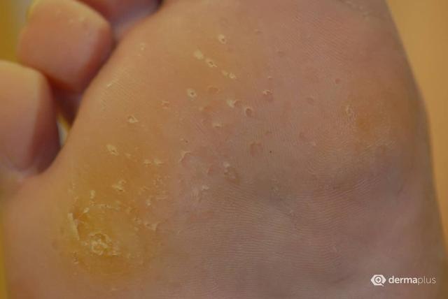 Keratoma sulcatum selbst behandeln: Effektive Methoden Keratoma sulcatum selbst behandeln: Effektive Methoden