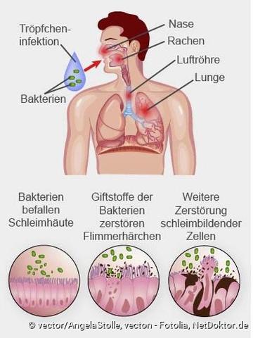 Keuchhusten: Eine hochansteckende Infektionskrankheit der Atemwege Keuchhusten: Eine hochansteckende Infektionskrankheit der Atemwege
