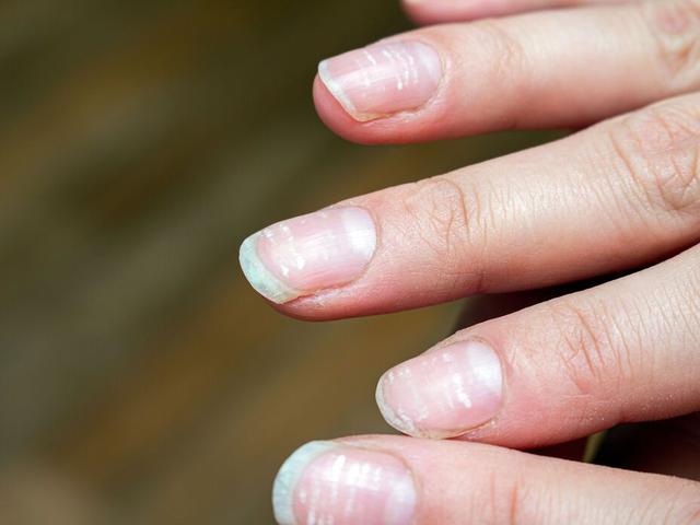 Natürliche Methoden zur Behandlung von Längsrillen an den Fingernägeln Natürliche Methoden zur Behandlung von Längsrillen an den Fingernägeln