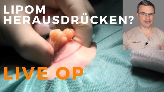 Die Wahrheit über die selbstständige Entfernung von Lipomen: Fakten und Mythen Die Wahrheit über die selbstständige Entfernung von Lipomen: Fakten und Mythen