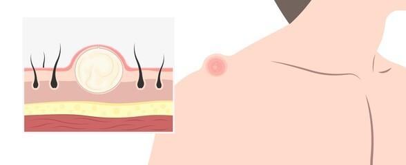 Alles über Lipome: Definition, Entstehung und chirurgische Entfernung Alles über Lipome: Definition, Entstehung und chirurgische Entfernung